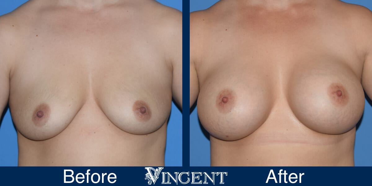 breast implants before and after utah