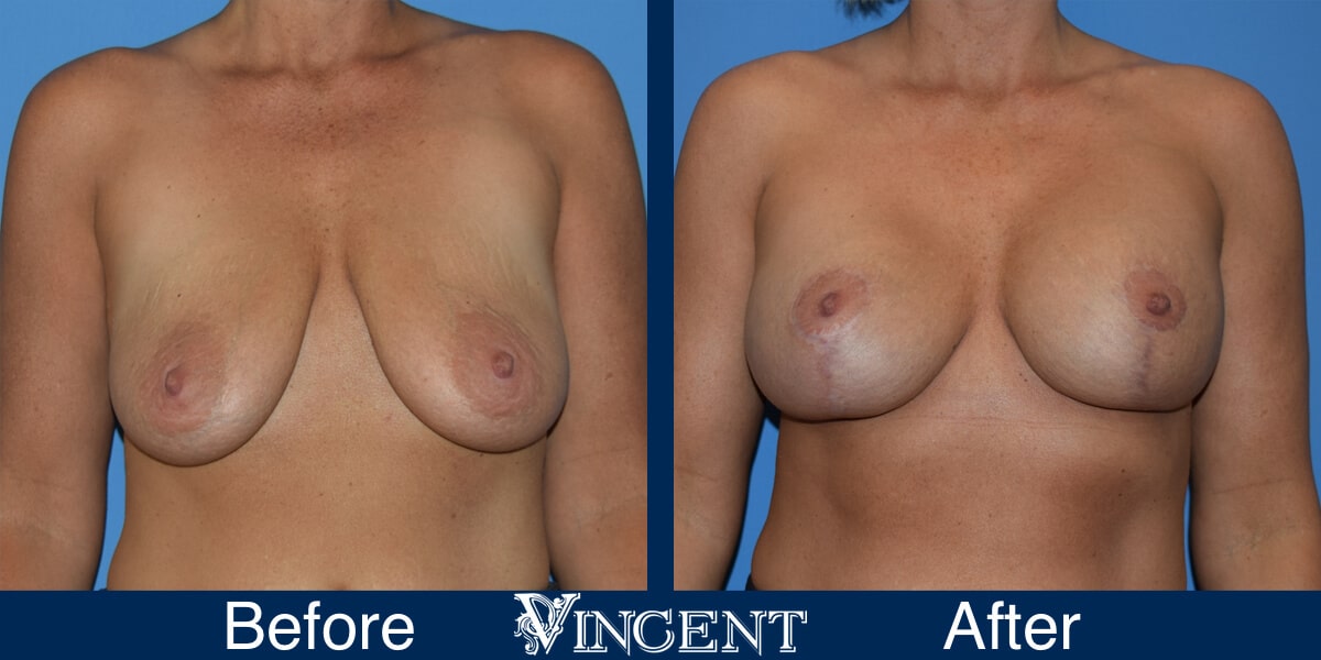breast lift before and after utah
