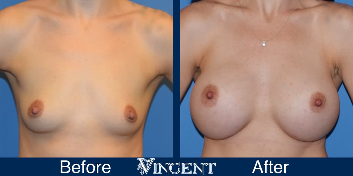 breast implants before and after utah