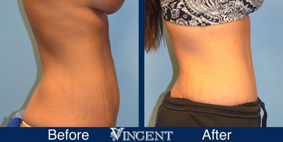 tummy tuck before and after photo utah