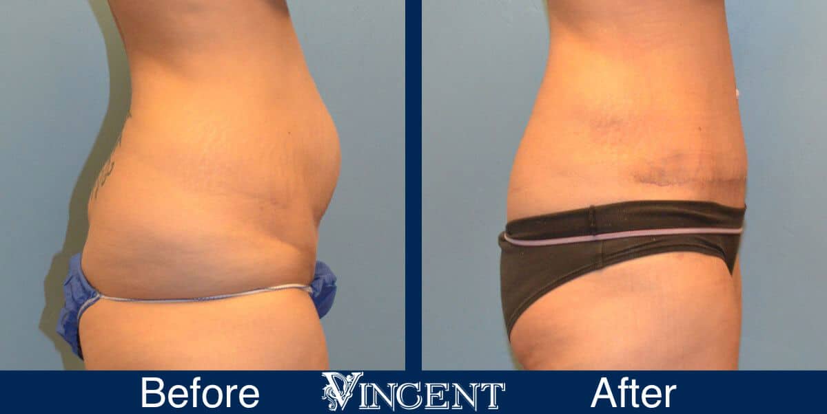 tummy tuck before and after photo utah