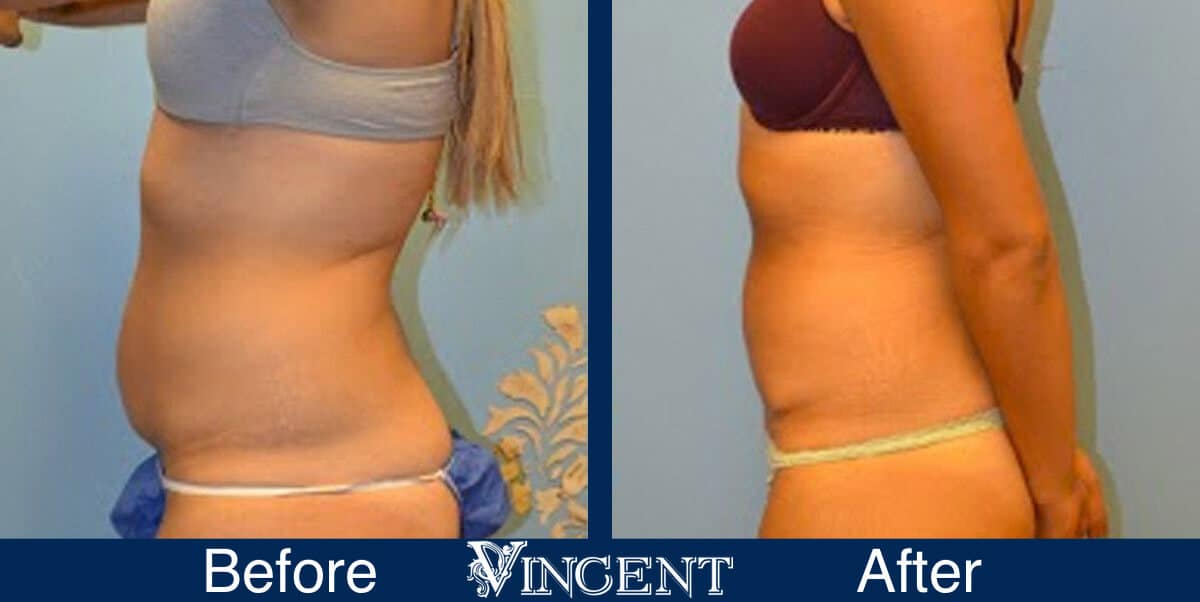 Patient #5745 Tummy Tuck (Abdominoplasty) Small Size Before and