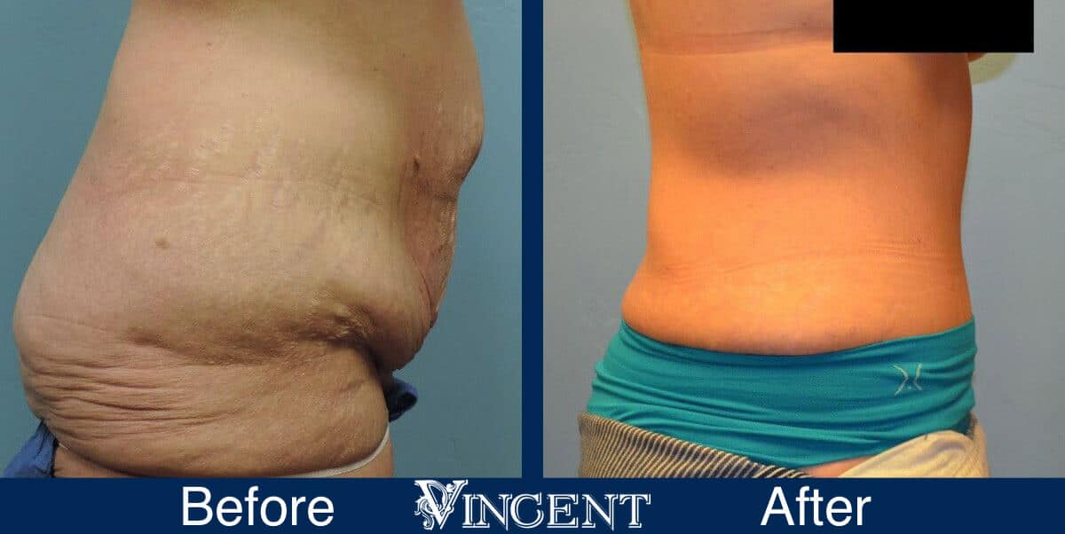 tummy tuck before and after photo utah