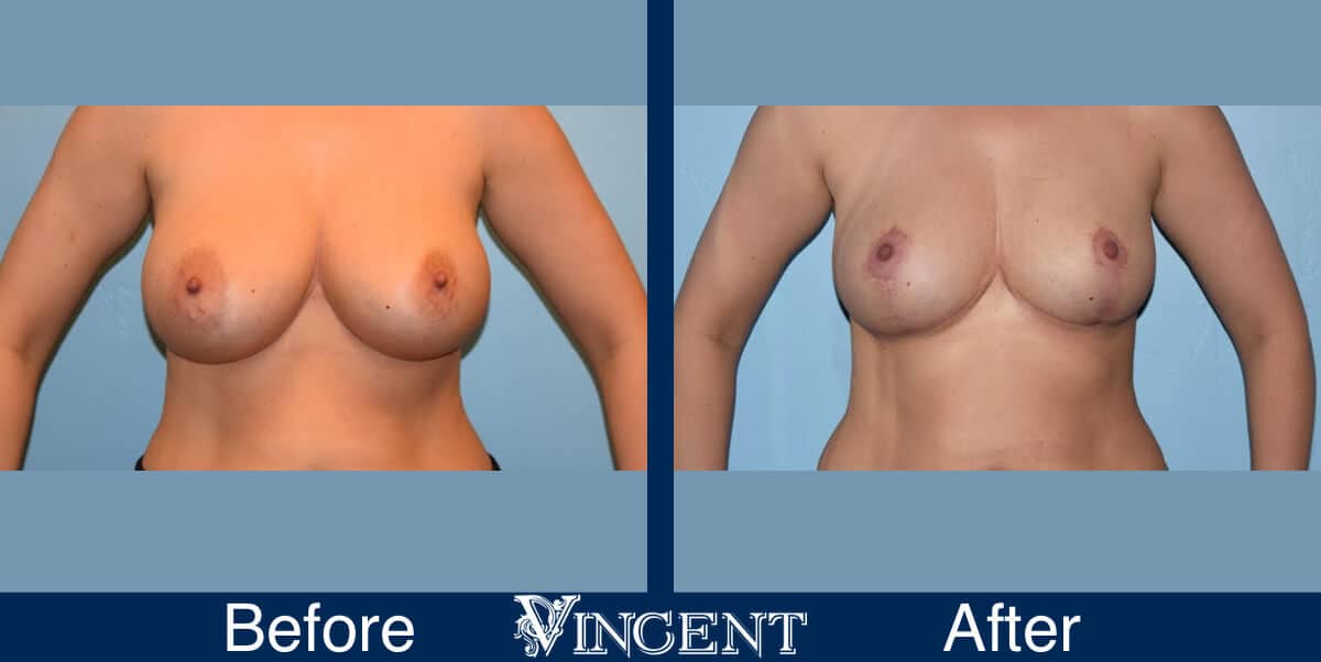 breast lift before and after utah