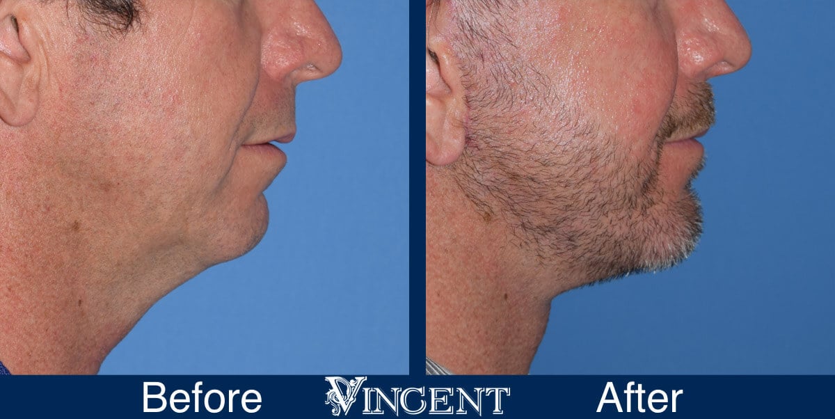 chin implant before and after male utah