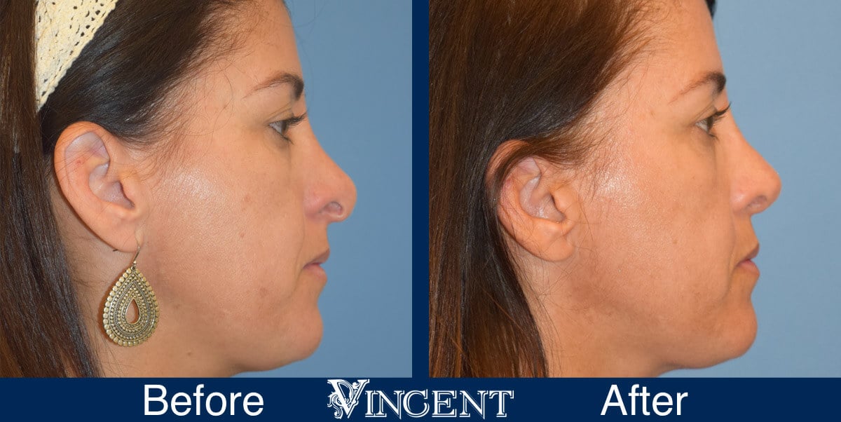 nose job before and after female photo utah