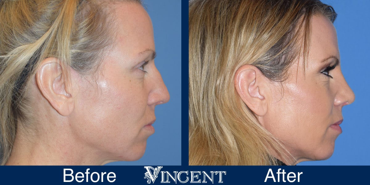 nose job before and after female photo utah