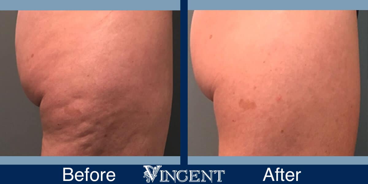 Cellulite Treatment with Profound RF Atlanta, Georgia