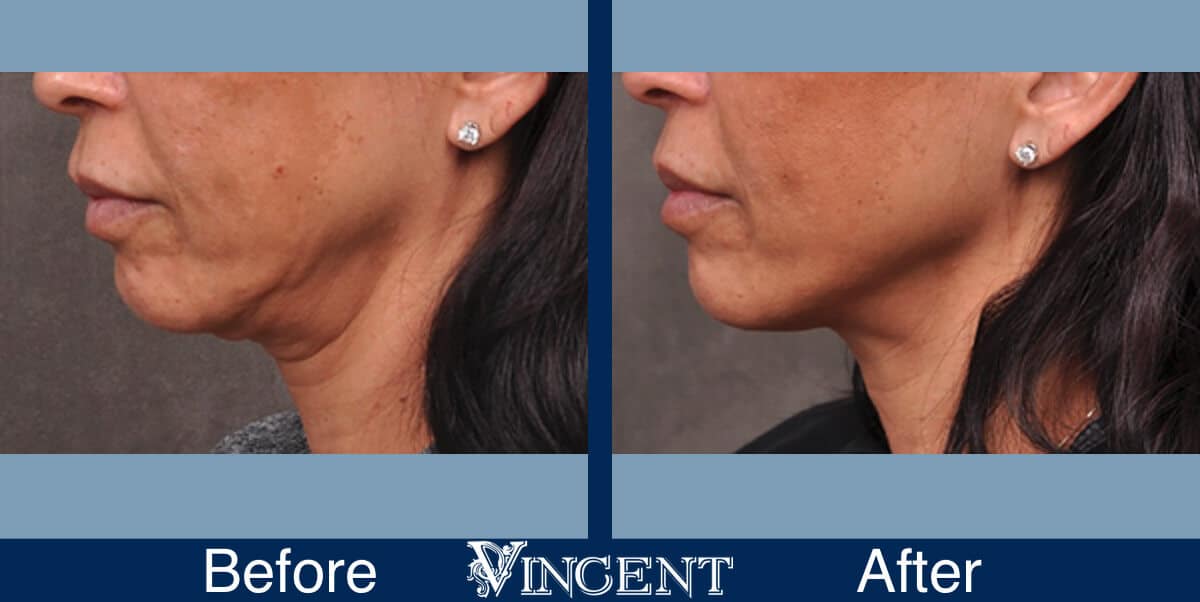 Patient 149342194, Profound RF Skin Tightening Before & After Photos