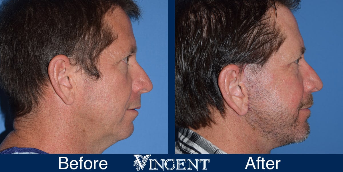 utah facelift before and after male