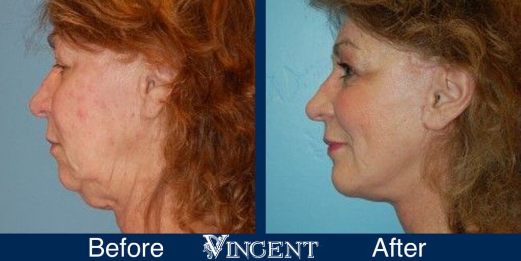 plastic-surgery-utah-facelift-before-and-after-side-main (1)