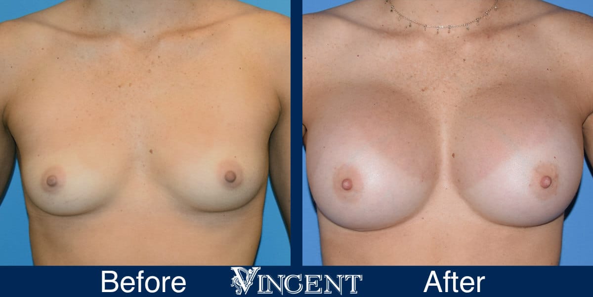 breast augmentation before and after utah