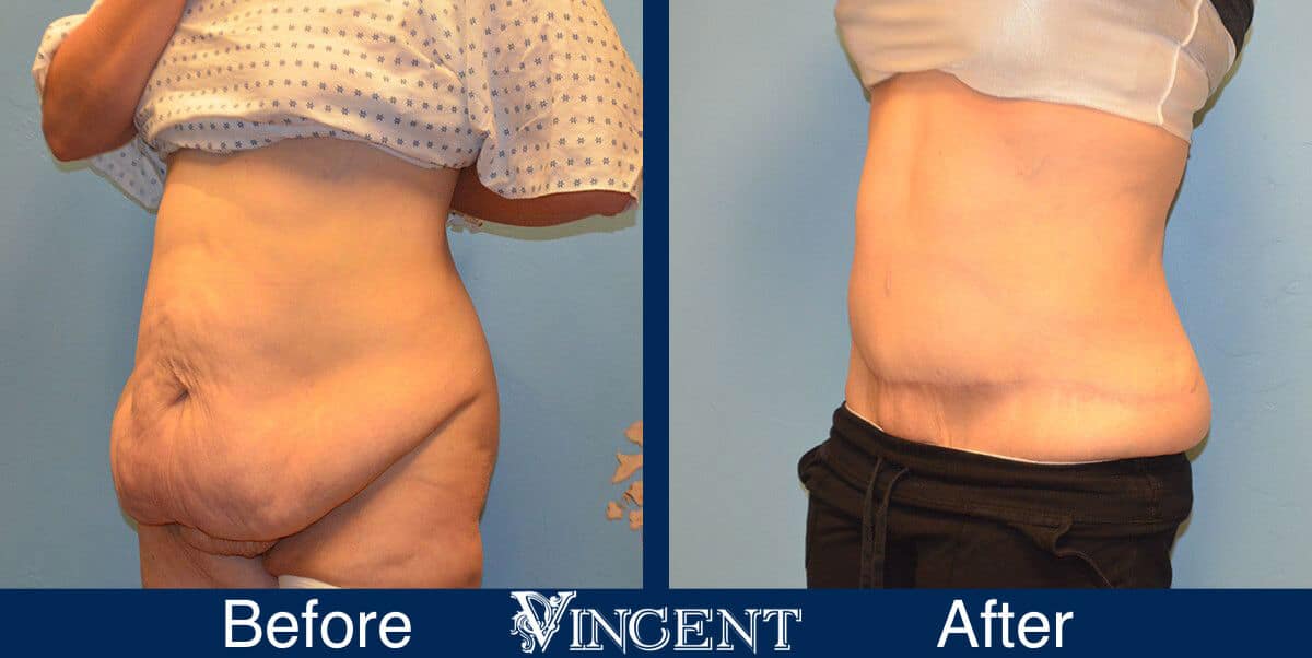 tummy tuck before and after photo abdominoplasty utah