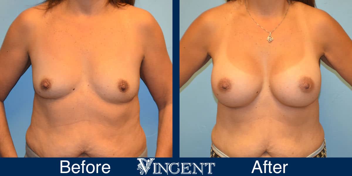 breast augmentation before and after utah