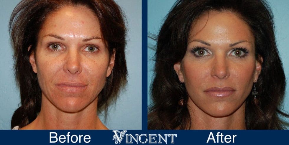 Face Gallery Vincent Surgical Arts &amp; Medspa
