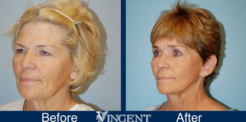 utah facelift before and after female