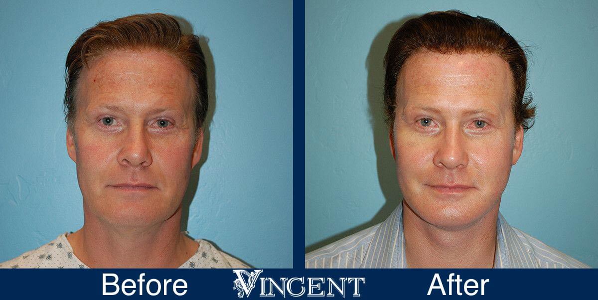 utah facelift before and after male