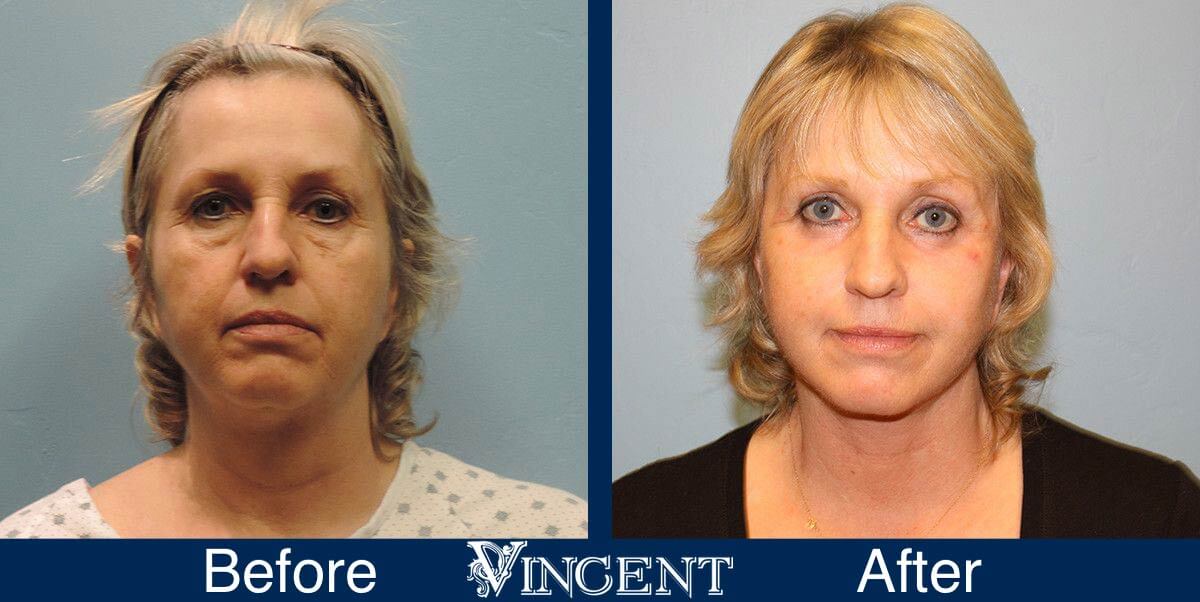 utah facelift before and after female