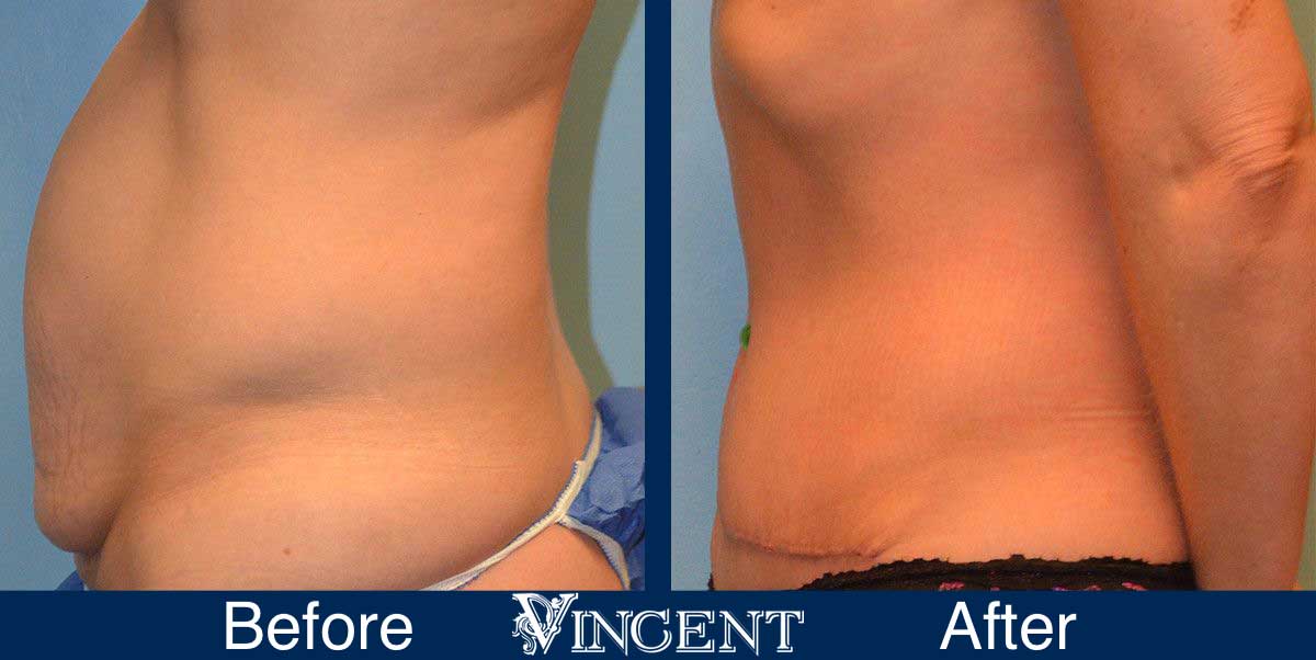 liposuction before and after utah