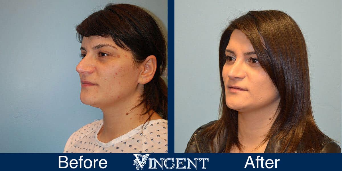 nose job before and after photo by vincent surgical arts