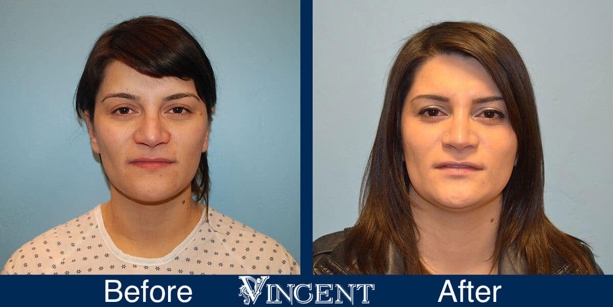 nose job before and after photo by vincent surgical arts