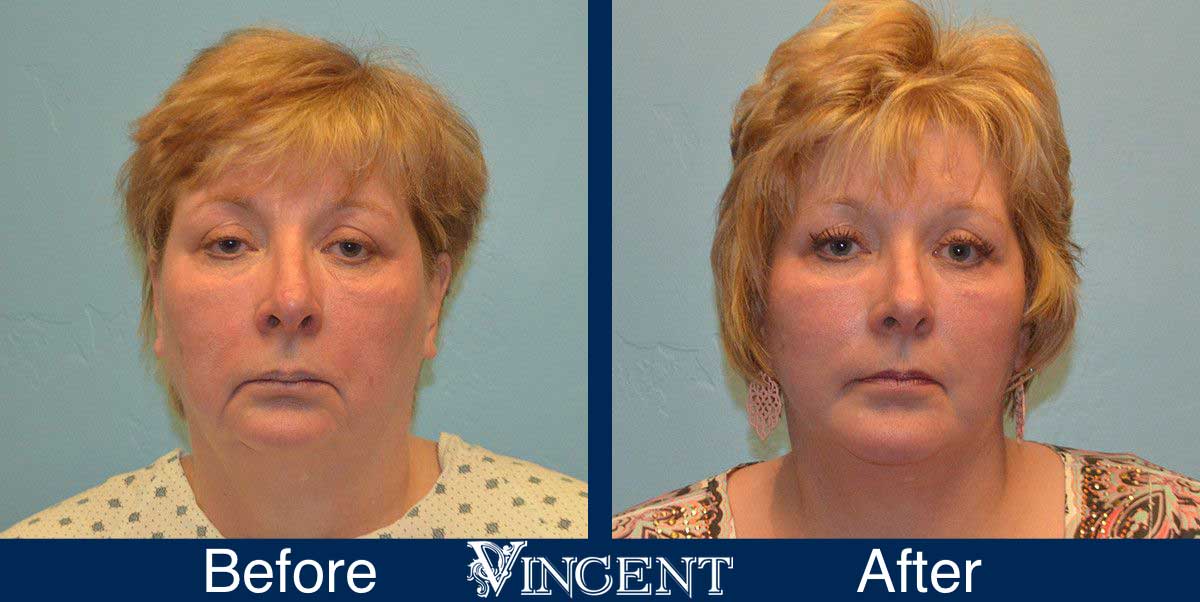 chin implant before and after female utah