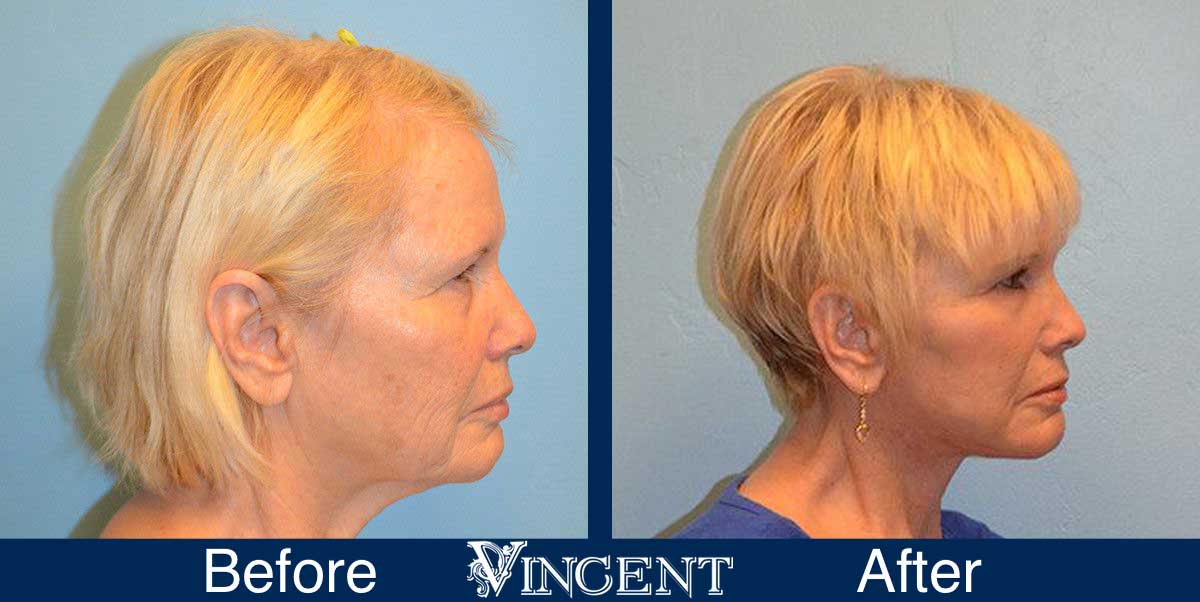 blepharoplasty before and after utah