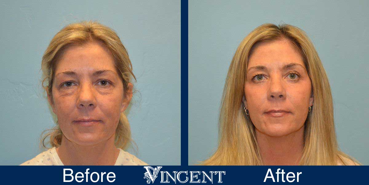 blepharoplasty before and after utah