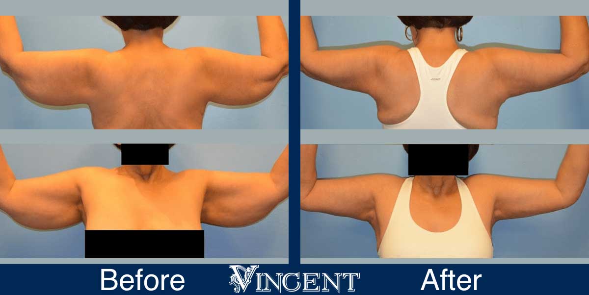brachioplasty before and after utah armlift