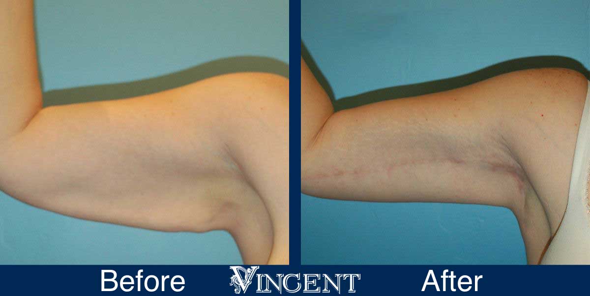 brachioplasty before and after utah armlift