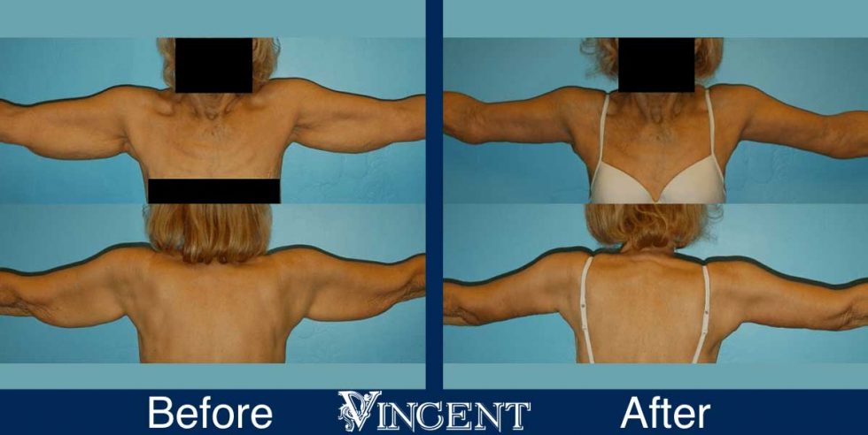 Arm Lift Brachioplasty Gallery Vincent Surgical Arts