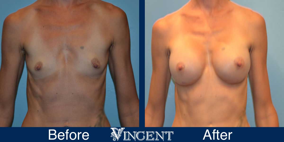 breast augmentation before and after utah
