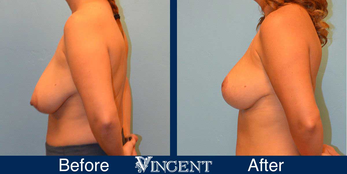 breast reduction before and after utah