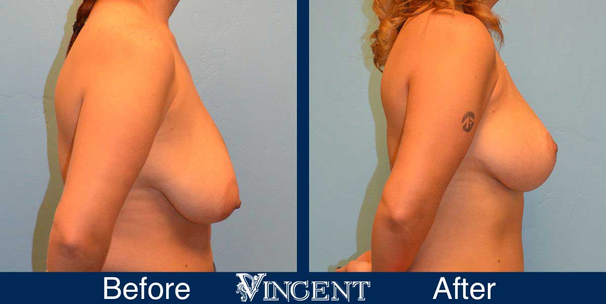 breast reduction before and after utah