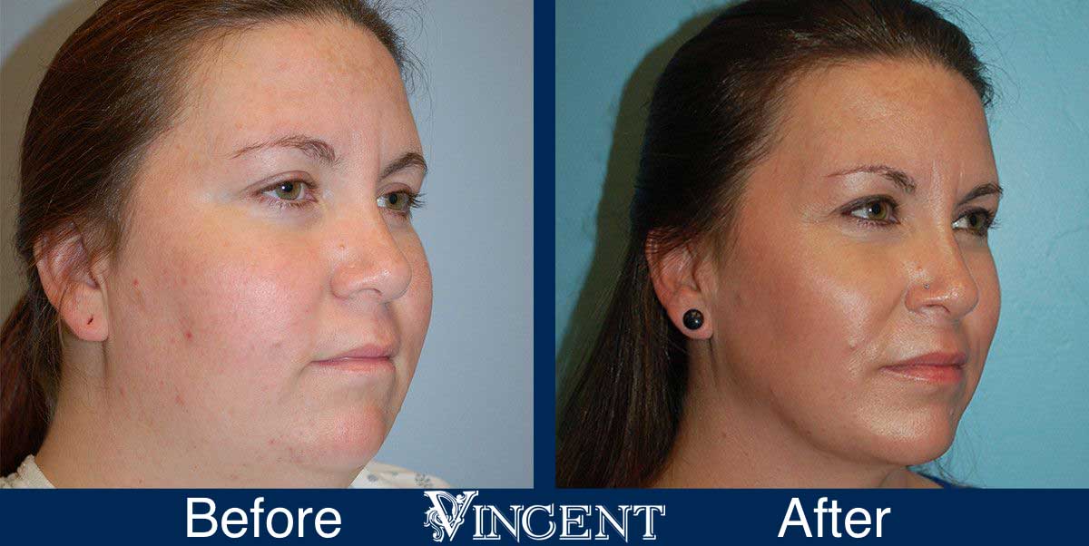 chin implant before and after female utah