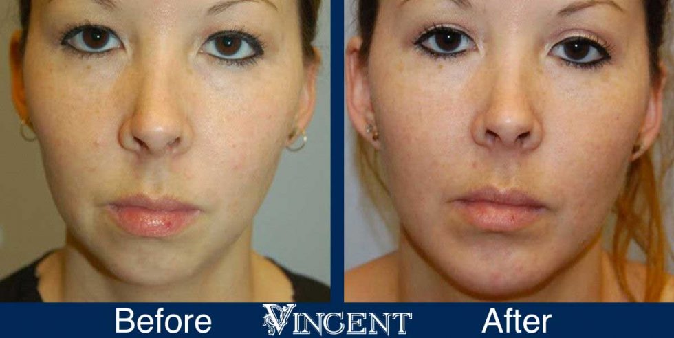 Chin Cheek Lip Augmentation Gallery Vincent Surgical Arts