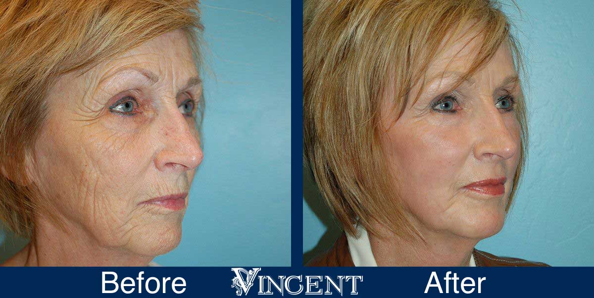 co2 laser treatment before and after utah