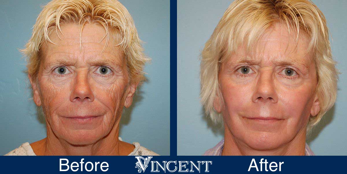 facial fat grafting before and after utah