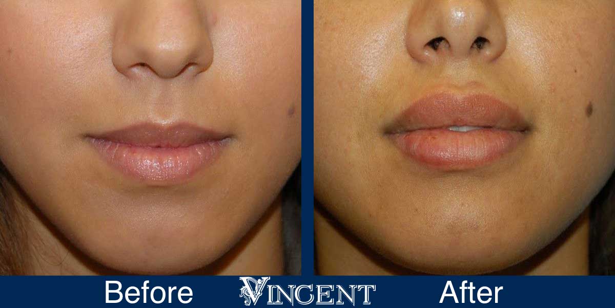 lip augmentation before and after utah