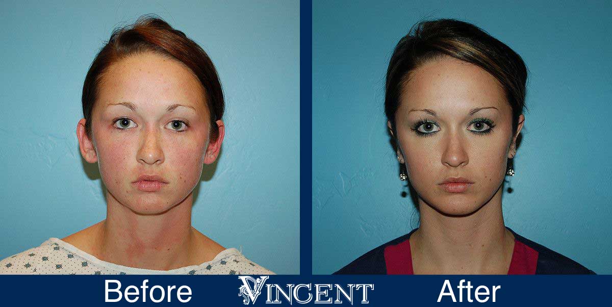 otoplasty before and after utah