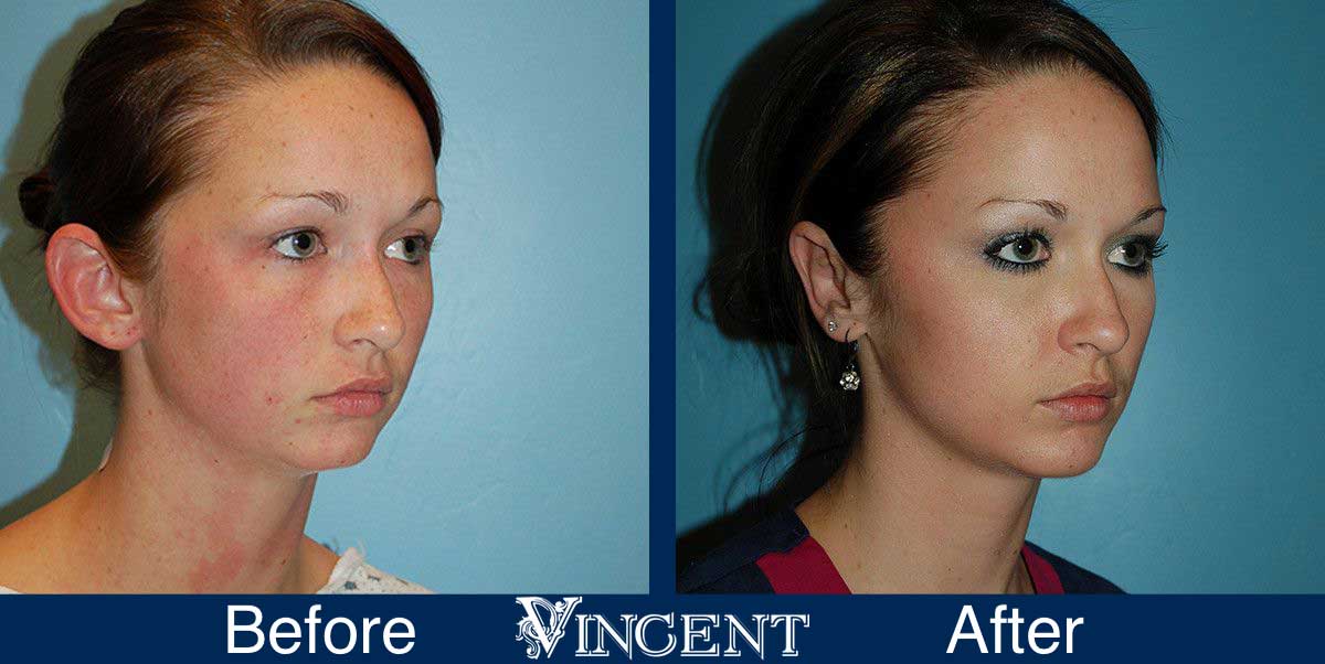 otoplasty before and after utah