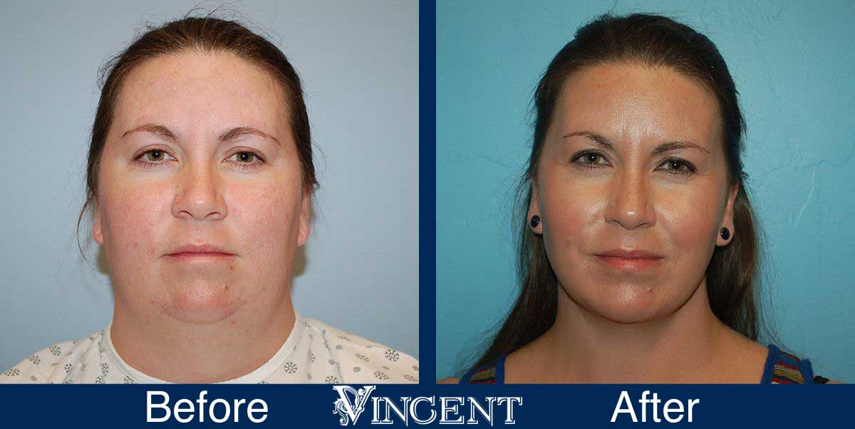 submental liposuction before and after utah vincent surgical arts