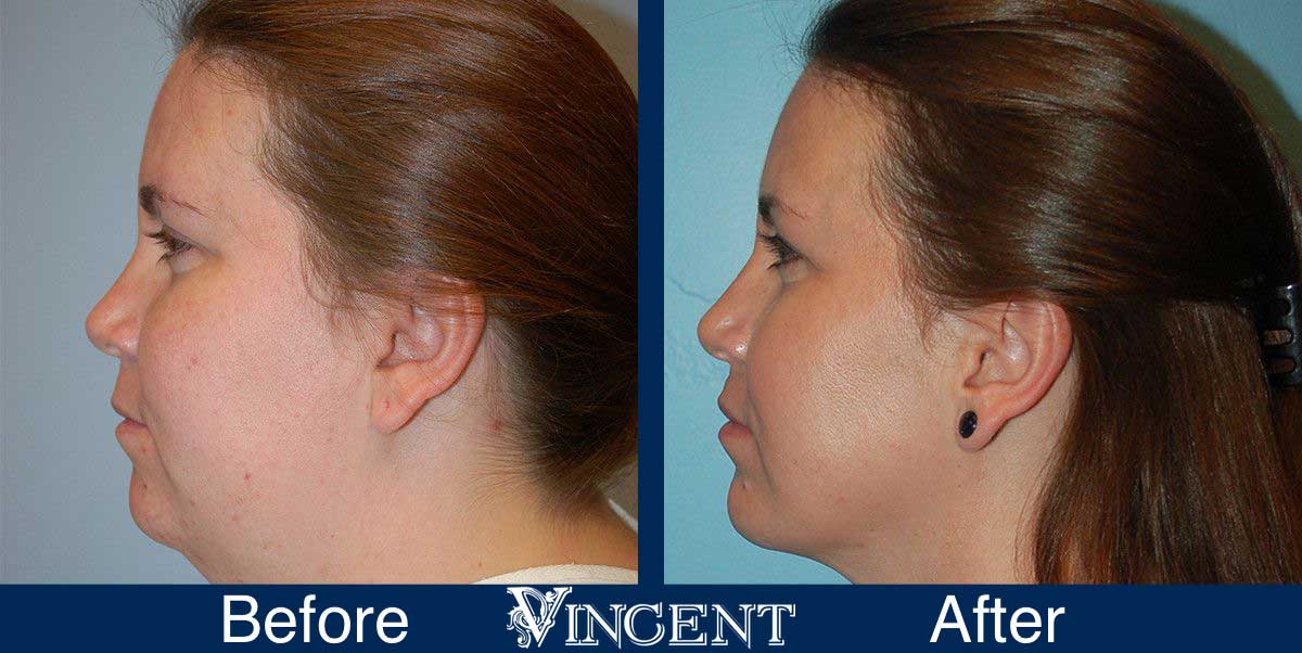 submental liposuction before and after utah vincent surgical arts