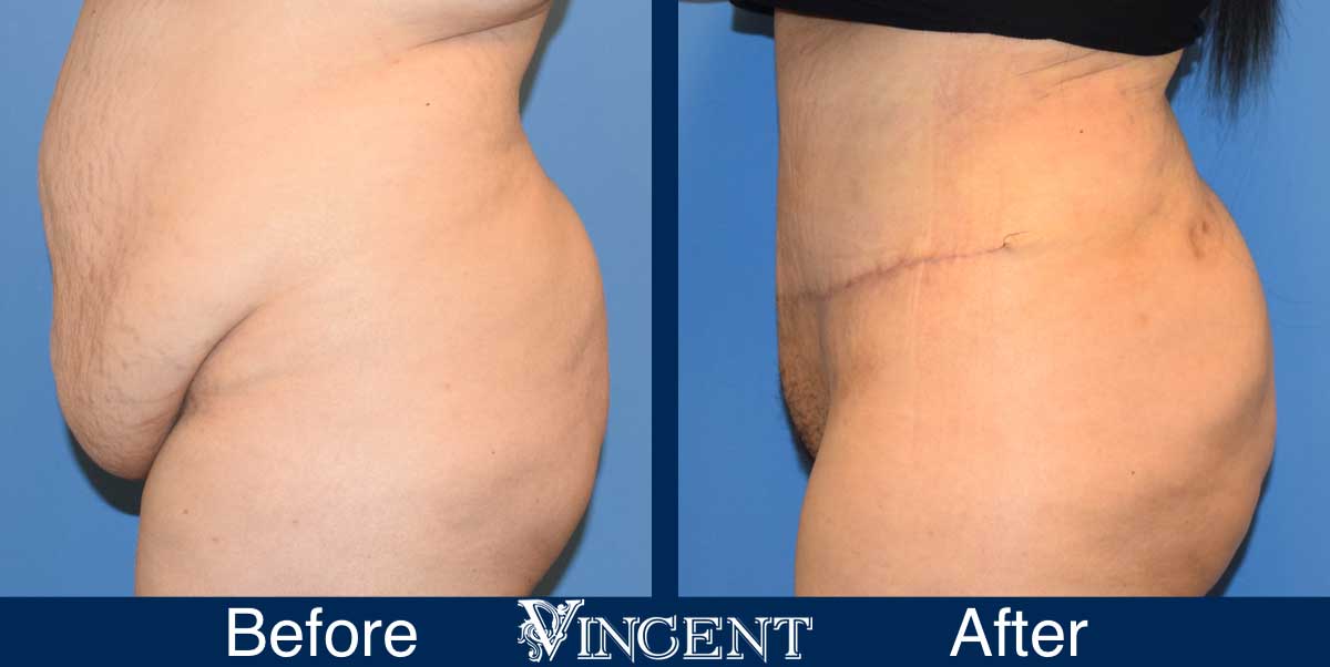 tummy tuck before and after photo abdominoplasty utah