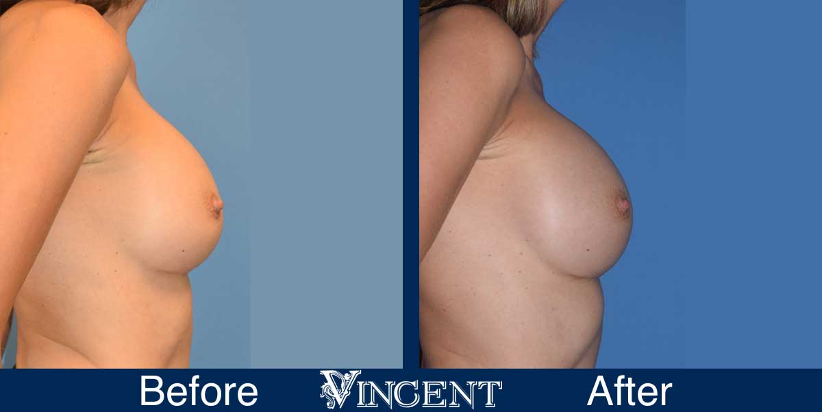 breast augmentation replacement before and after utah