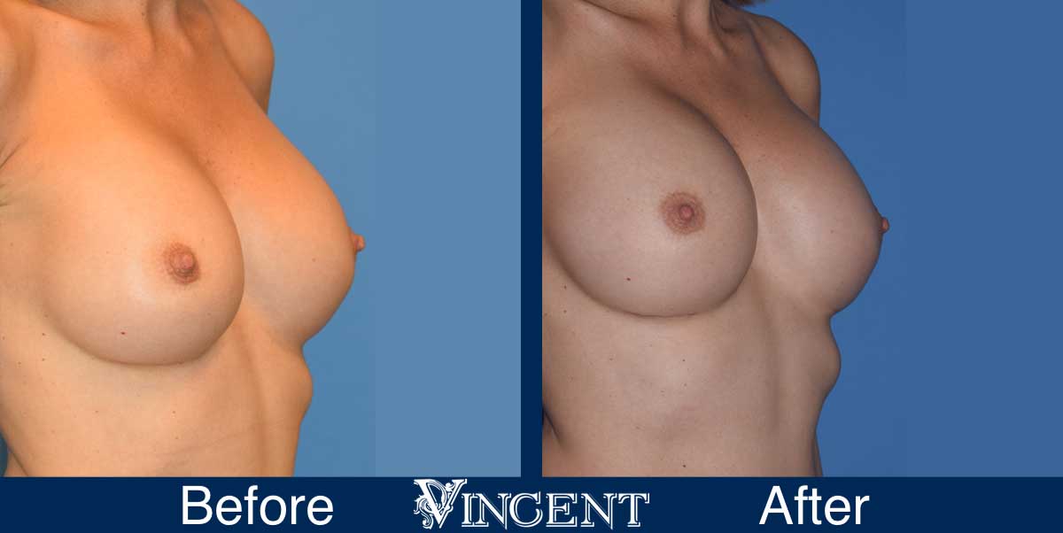 breast augmentation replacement before and after utah