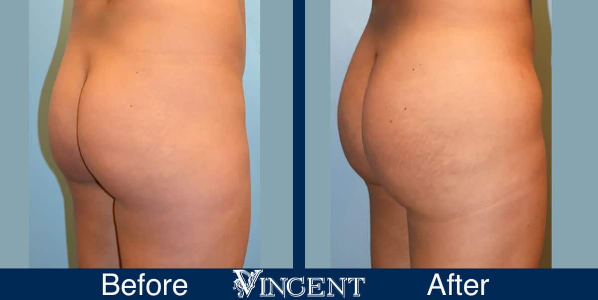 Vincent Surgical Arts  Brazilian Butt Lift in Cottonwood Heights