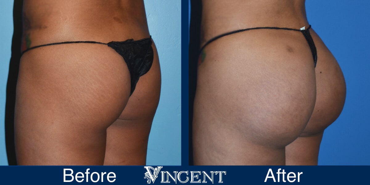 Brazilian Butt Lift Before and After Photos 2