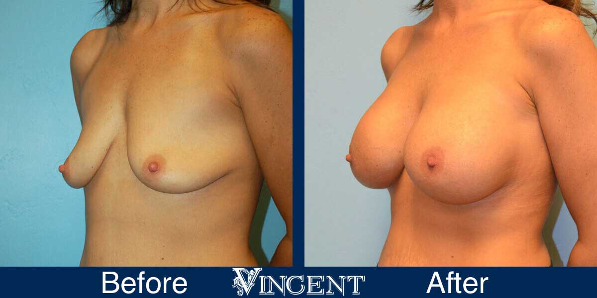 Breast Augmentation Before and After Photos 1
