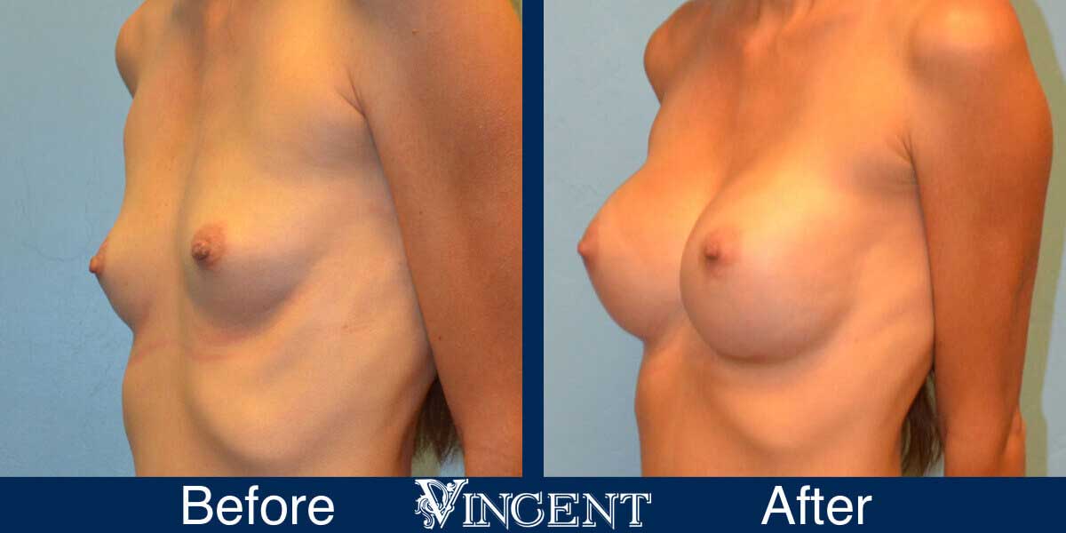 Breast Augmentation Before and After Photos 2